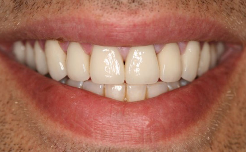 Smile Gallery - Portmore Dental
